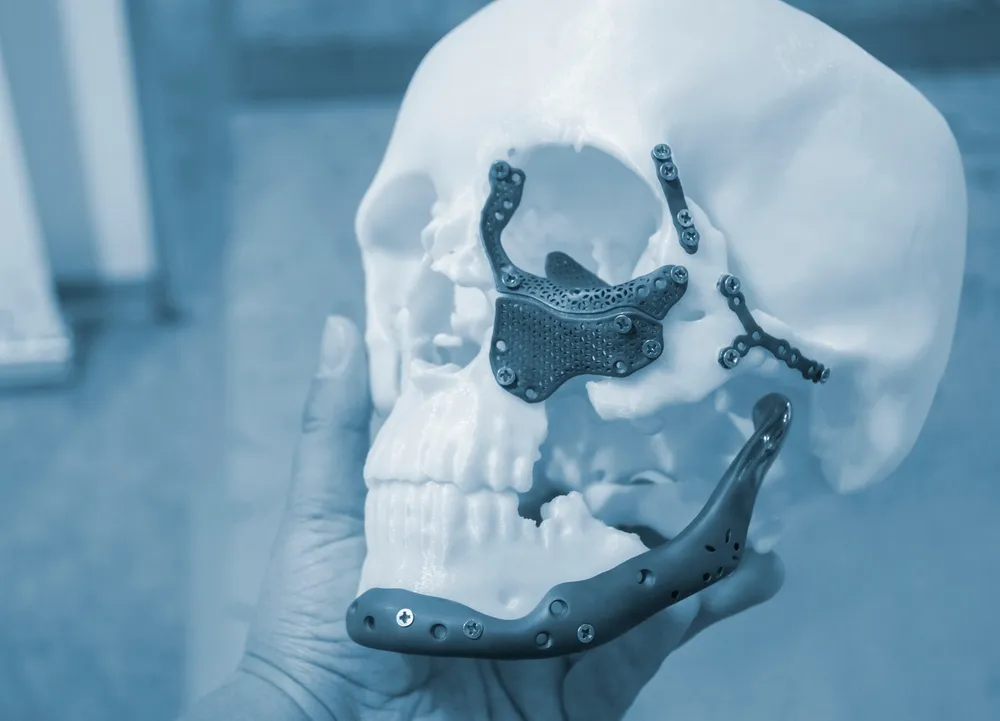 proteses osseas em impressao 3d